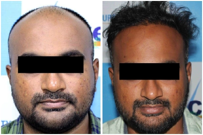 Hair Transplant Treatment
